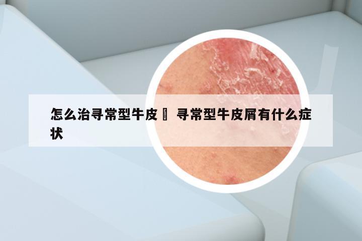 怎么治寻常型牛皮廯 寻常型牛皮屑有什么症状