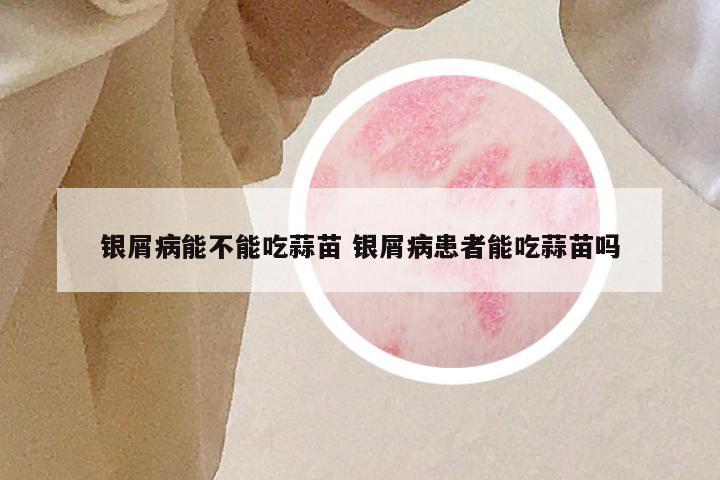 银屑病能不能吃蒜苗 银屑病患者能吃蒜苗吗
