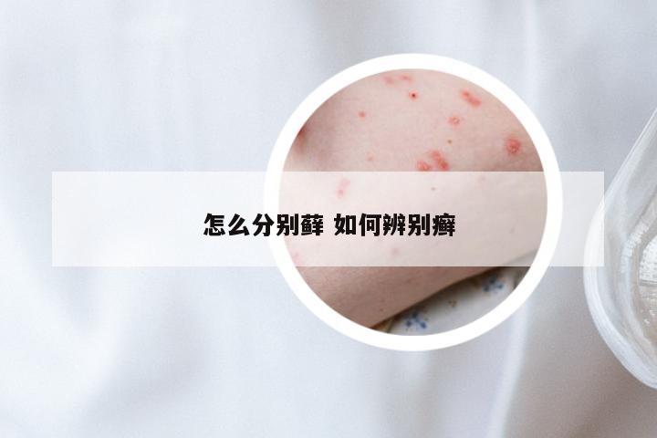 怎么分别藓 如何辨别癣