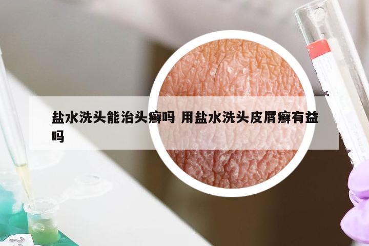 盐水洗头能治头癣吗 用盐水洗头皮屑癣有益吗