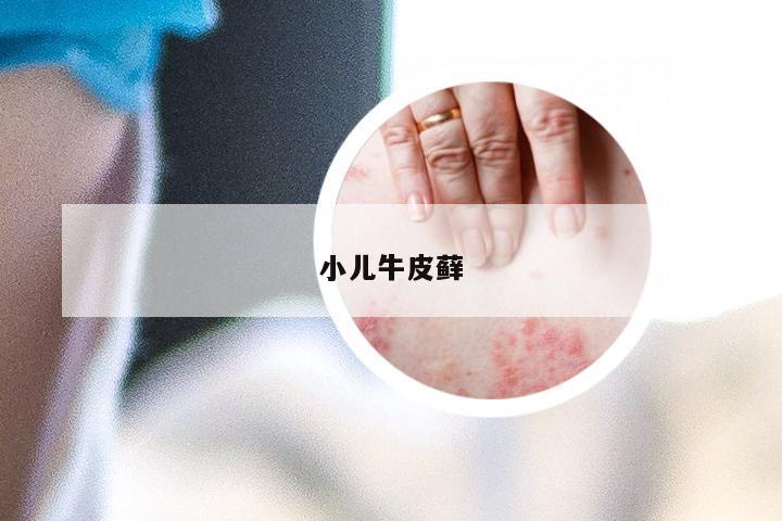 小儿牛皮藓