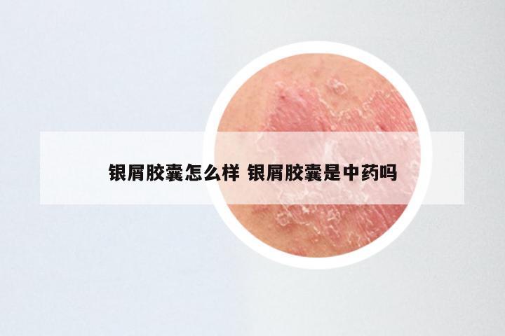 银屑胶囊怎么样 银屑胶囊是中药吗