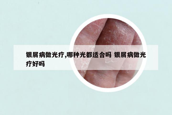 银屑病做光疗,哪种光都适合吗 银屑病做光疗好吗