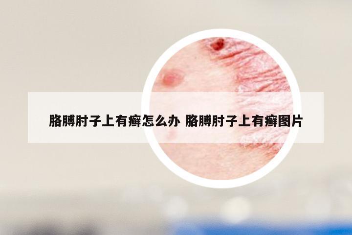 胳膊肘子上有癣怎么办 胳膊肘子上有癣图片