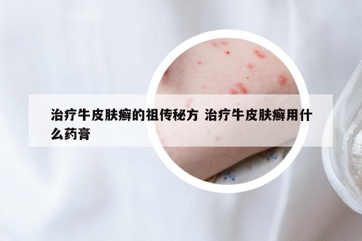 治疗牛皮肤癣的祖传秘方 治疗牛皮肤癣用什么药膏