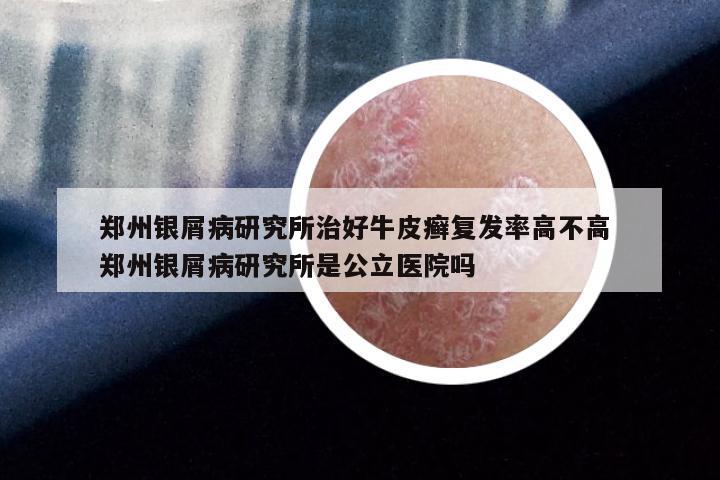 郑州银屑病研究所治好牛皮癣复发率高不高 郑州银屑病研究所是公立医院吗