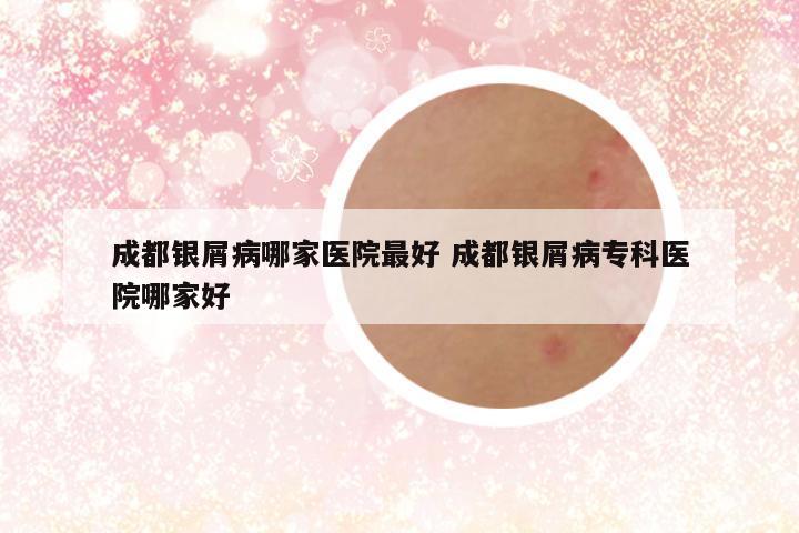 成都银屑病哪家医院最好 成都银屑病专科医院哪家好