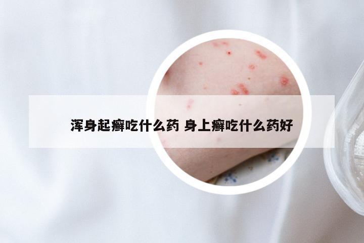 浑身起癣吃什么药 身上癣吃什么药好