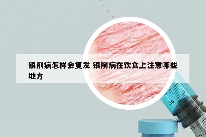 银削病怎样会复发 银削病在饮食上注意哪些地方