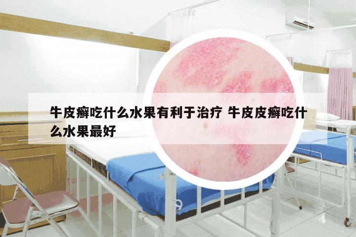 牛皮癣吃什么水果有利于治疗 牛皮皮癣吃什么水果最好