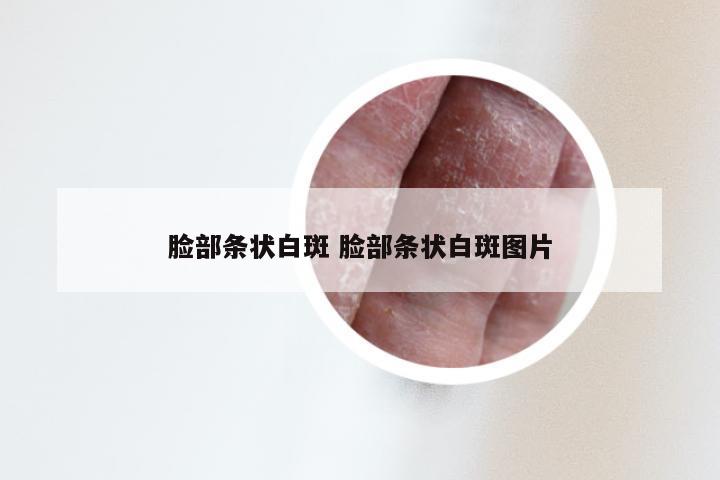 脸部条状白斑 脸部条状白斑图片
