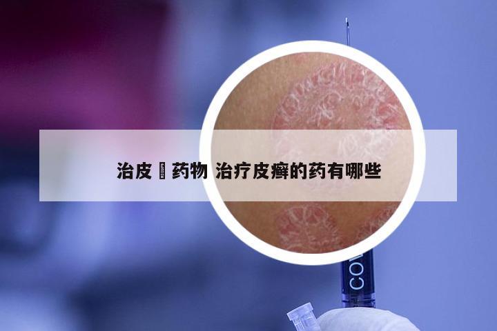 治皮廯药物 治疗皮癣的药有哪些