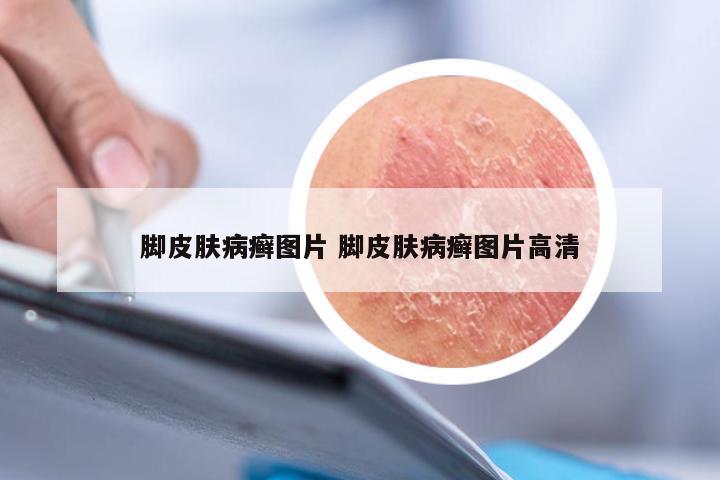 脚皮肤病癣图片 脚皮肤病癣图片高清