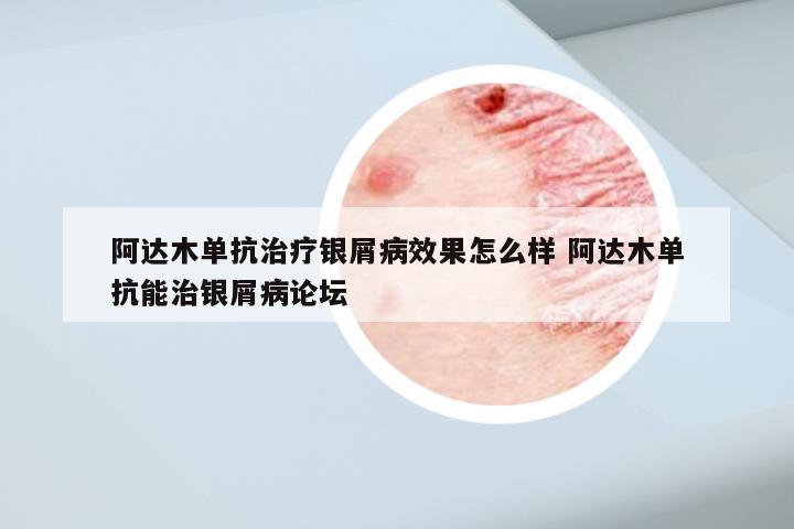 阿达木单抗治疗银屑病效果怎么样 阿达木单抗能治银屑病论坛