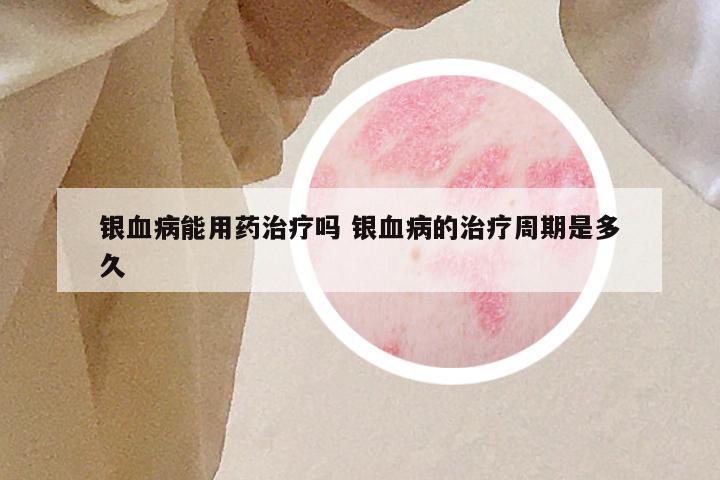 银血病能用药治疗吗 银血病的治疗周期是多久