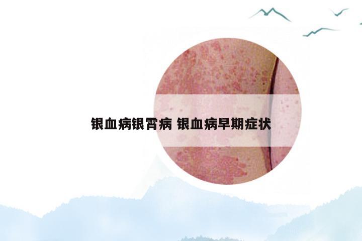 银血病银霄病 银血病早期症状