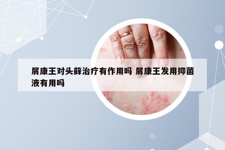 屑康王对头藓治疗有作用吗 屑康王发用抑菌液有用吗