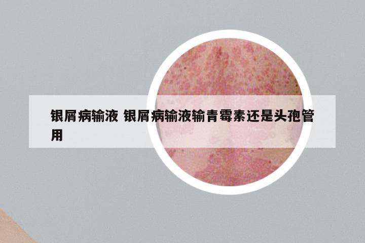 银屑病输液 银屑病输液输青霉素还是头孢管用