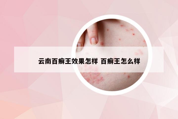 云南百癣王效果怎样 百癣王怎么样