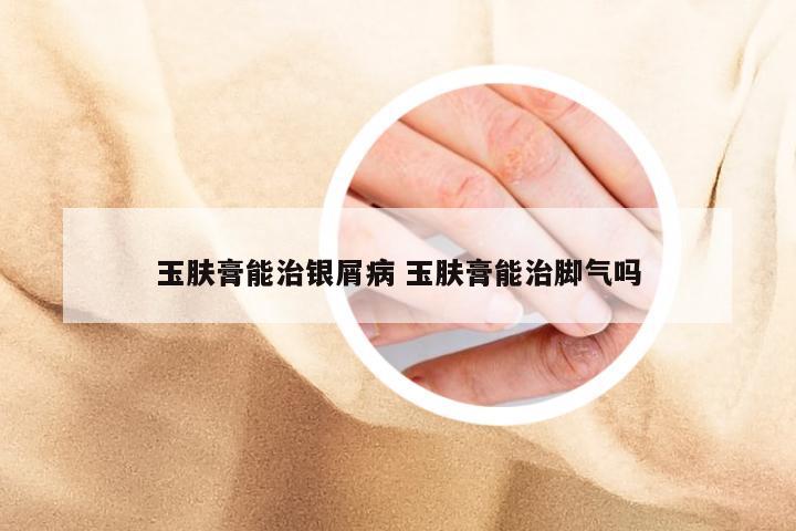 玉肤膏能治银屑病 玉肤膏能治脚气吗
