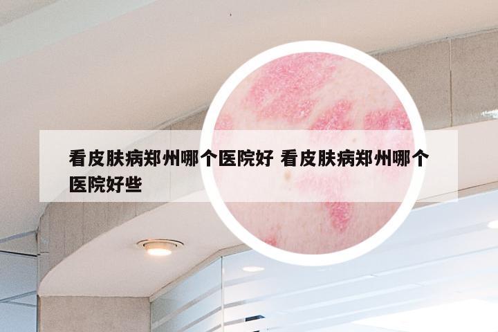看皮肤病郑州哪个医院好 看皮肤病郑州哪个医院好些