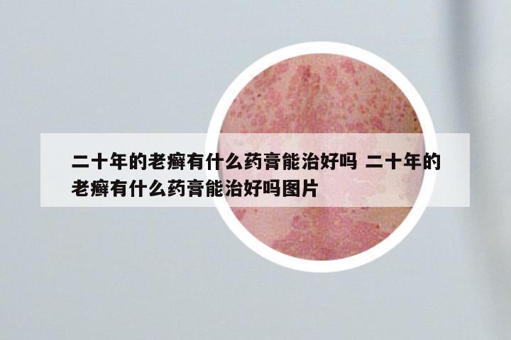 二十年的老癣有什么药膏能治好吗 二十年的老癣有什么药膏能治好吗图片