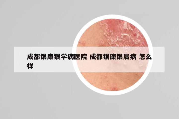 成都银康银学病医院 成都银康银屑病 怎么样