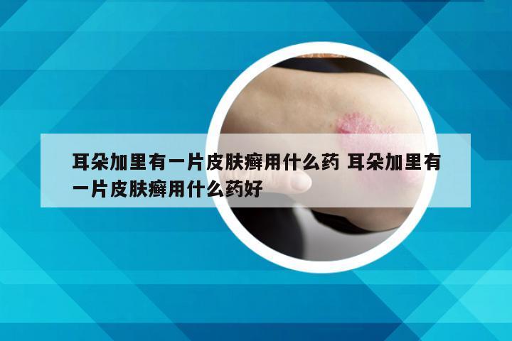 耳朵加里有一片皮肤癣用什么药 耳朵加里有一片皮肤癣用什么药好