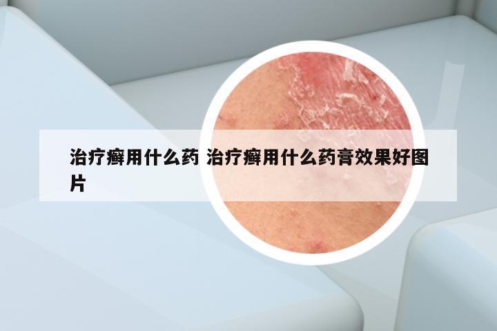 治疗癣用什么药 治疗癣用什么药膏效果好图片