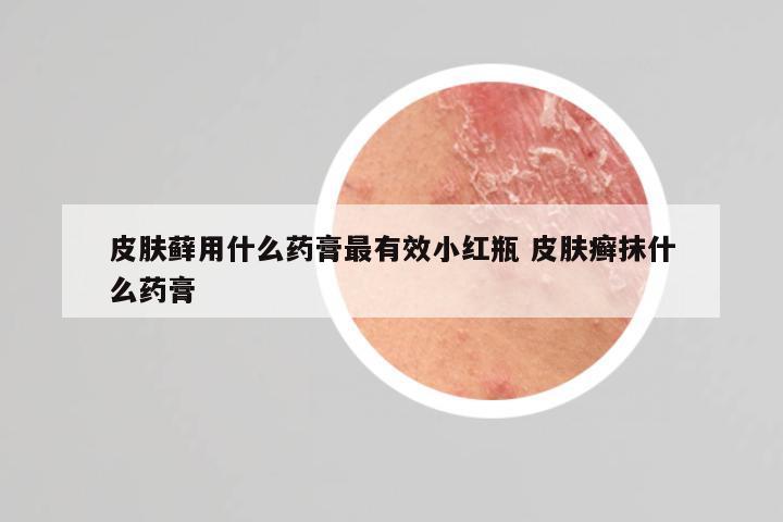 皮肤藓用什么药膏最有效小红瓶 皮肤癣抹什么药膏
