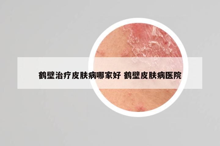 鹤壁治疗皮肤病哪家好 鹤壁皮肤病医院