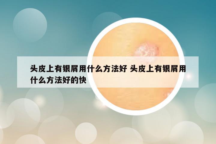 头皮上有银屑用什么方法好 头皮上有银屑用什么方法好的快
