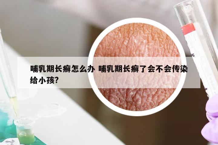 哺乳期长癣怎么办 哺乳期长癣了会不会传染给小孩?