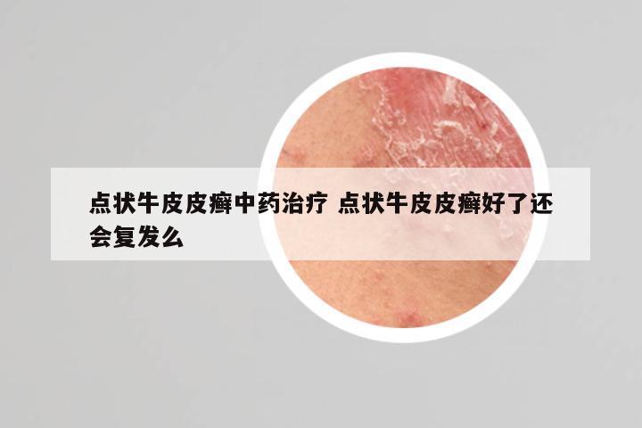 点状牛皮皮癣中药治疗 点状牛皮皮癣好了还会复发么