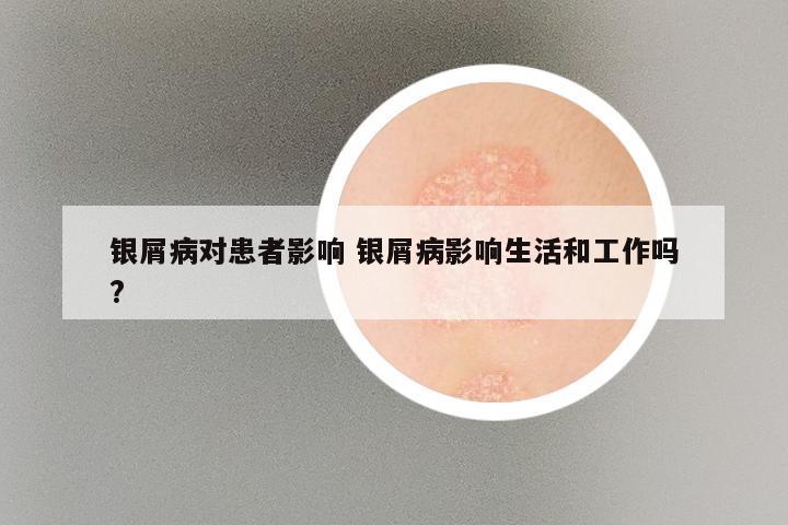 银屑病对患者影响 银屑病影响生活和工作吗?