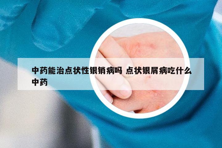 中药能治点状性银销病吗 点状银屑病吃什么中药