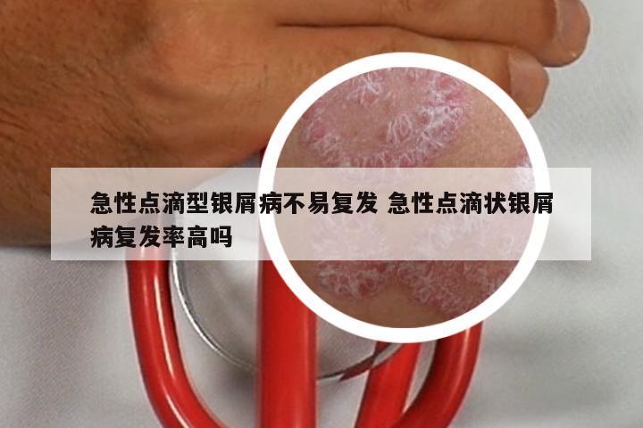 急性点滴型银屑病不易复发 急性点滴状银屑病复发率高吗