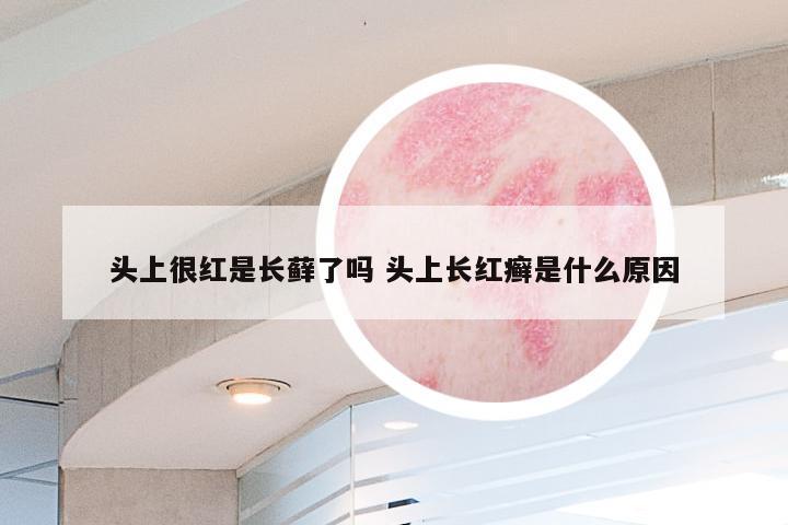 头上很红是长藓了吗 头上长红癣是什么原因
