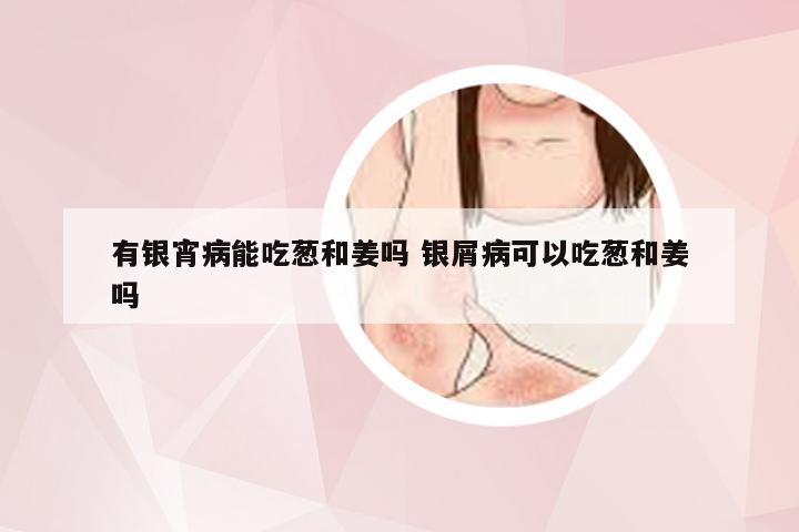 有银宵病能吃葱和姜吗 银屑病可以吃葱和姜吗
