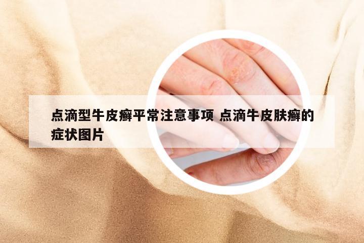 点滴型牛皮癣平常注意事项 点滴牛皮肤癣的症状图片