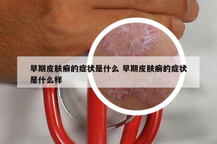 早期皮肤癣的症状是什么 早期皮肤癣的症状是什么样