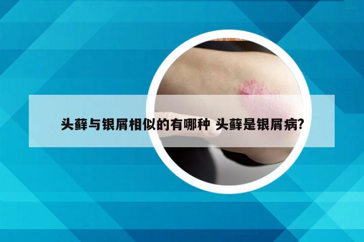 头藓与银屑相似的有哪种 头藓是银屑病?