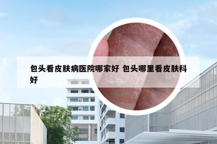 包头看皮肤病医院哪家好 包头哪里看皮肤科好