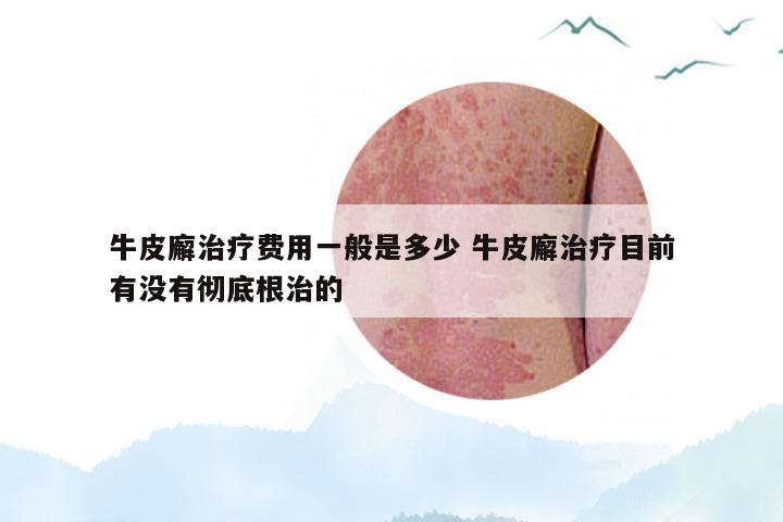 牛皮廨治疗费用一般是多少 牛皮廨治疗目前有没有彻底根治的