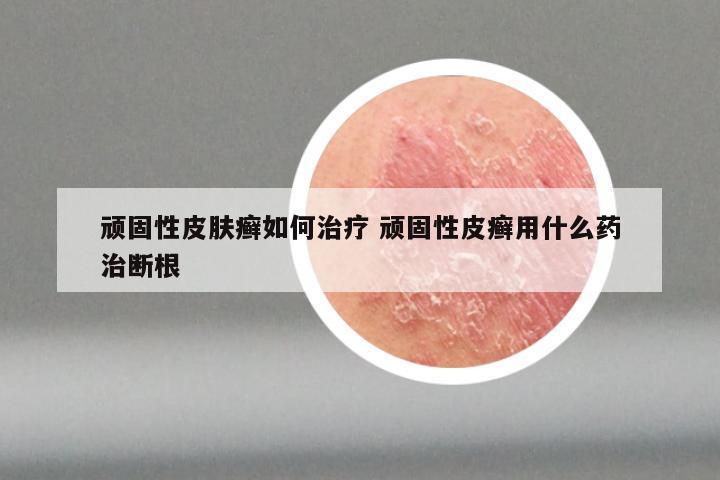 顽固性皮肤癣如何治疗 顽固性皮癣用什么药治断根