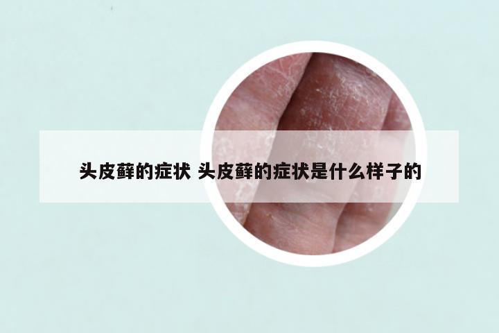头皮藓的症状 头皮藓的症状是什么样子的