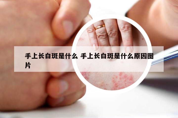 手上长白斑是什么 手上长白斑是什么原因图片