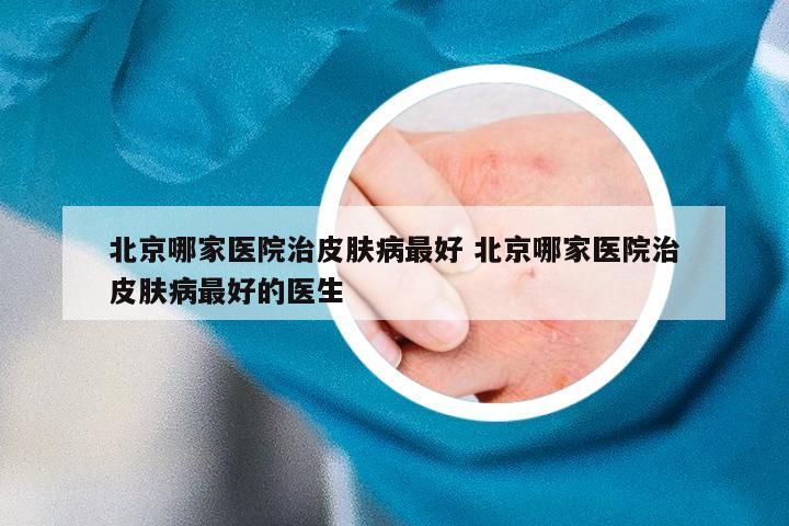 北京哪家医院治皮肤病最好 北京哪家医院治皮肤病最好的医生
