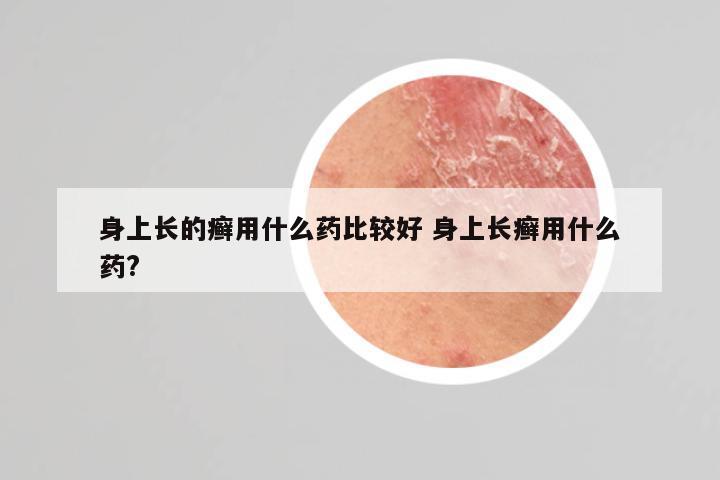 身上长的癣用什么药比较好 身上长癣用什么药?