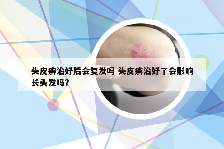 头皮癣治好后会复发吗 头皮癣治好了会影响长头发吗?